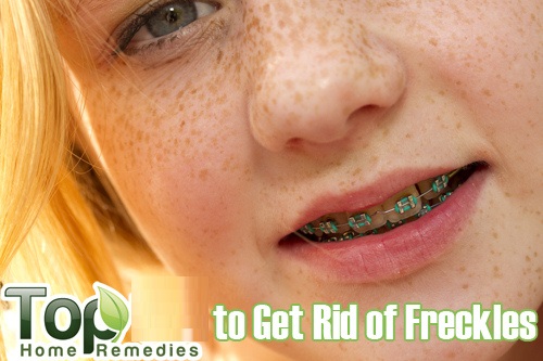 home-made-remedies-to-get-rid-of-freckles