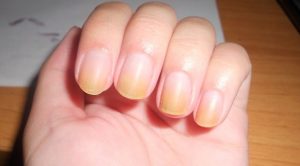 yellow nails remedies